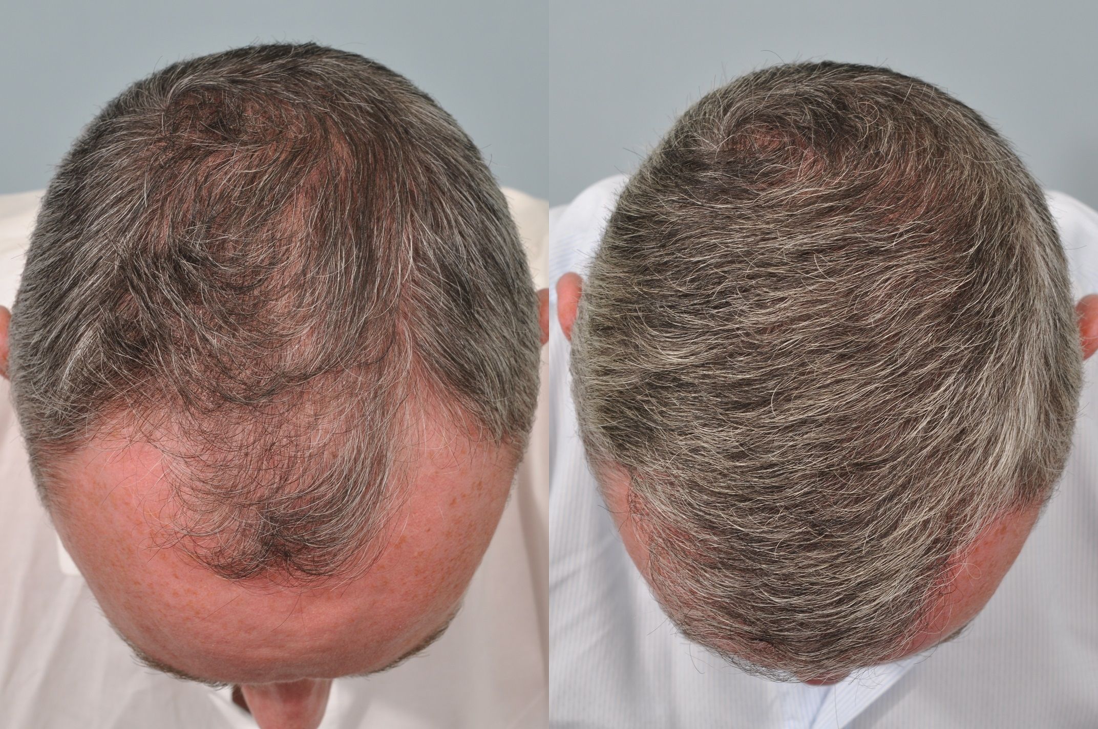 hair-transplant-Islamabad-Before and after results