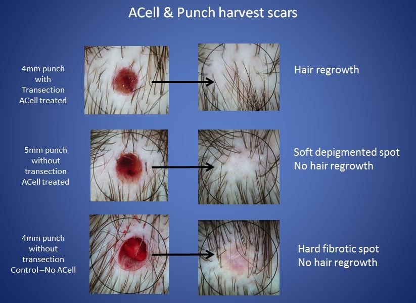 Acell Therapy Scar Removal