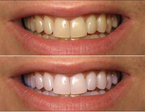 Teeth Whitening in Islamabad, Rawalpindi Before and After.
