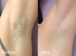 Laser Hair Removal in Islamabad, Pakistan