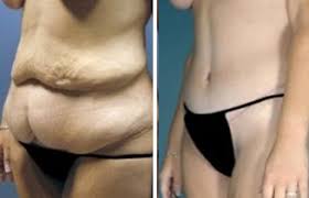 How much does a tummy tuck cost in Pakistan?, by DR NAVEED A KHAN