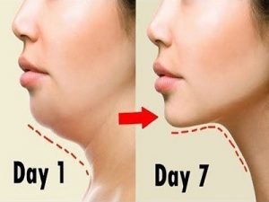 Double Chin Liposuction in Islamabad, Rawalpindi & Pakistan