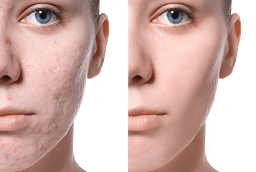 Permanent Acne Scars Treatment in Pakistan