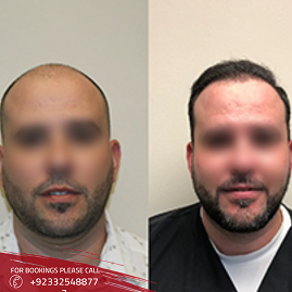 Best Hair Transplant clinic in Islamabad Before After