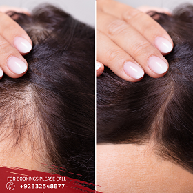 hair transplant Islamabad Before and After