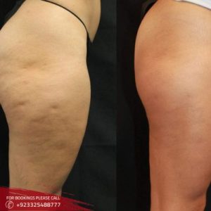 Thigh Liposuction cost in islamabad