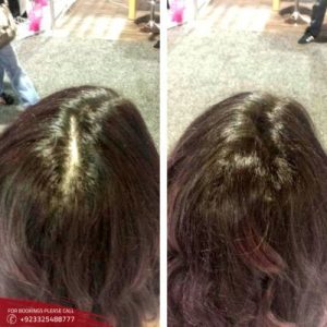 Hair Fillers for Baldness before after