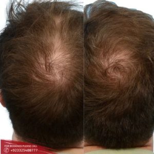 Non Surgical Hair Replacement before after