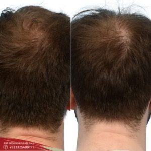 Results of Non Surgical Hair Replacement