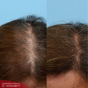 Non Surgical Hair Replacement cost in Islamabad
