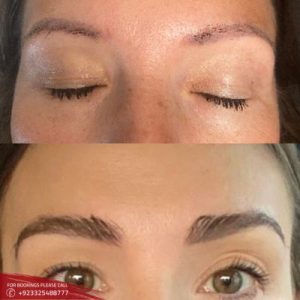 Eyebrow hair transplant before after