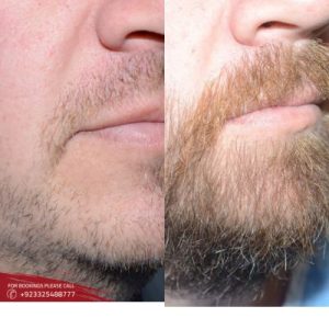 Moustache Hair Transplant cost in Islamabad