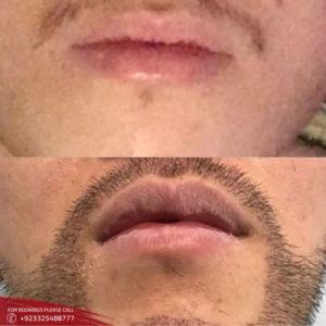 Moustache Hair Transplant before after