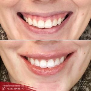 Gummy Smile Treatment cost in Islamabad