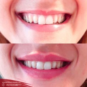 Results of Gummy Smile Treatment