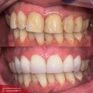 Results of Teeth Cleaning and Polishing 