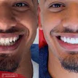 Results of Hollywood Smile Design treatment