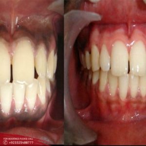 Results of Gum Depigmentation Treatment 