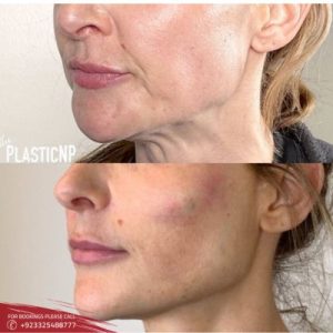 results of Jawline Contouring