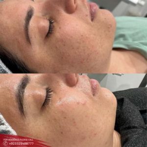 Results of Oxygen facial