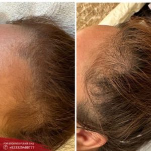 Exosomes hair therapy before after