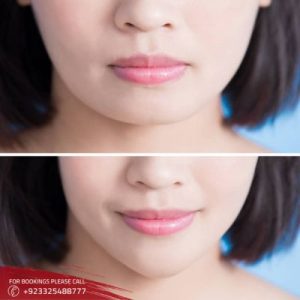 results of chin reducation