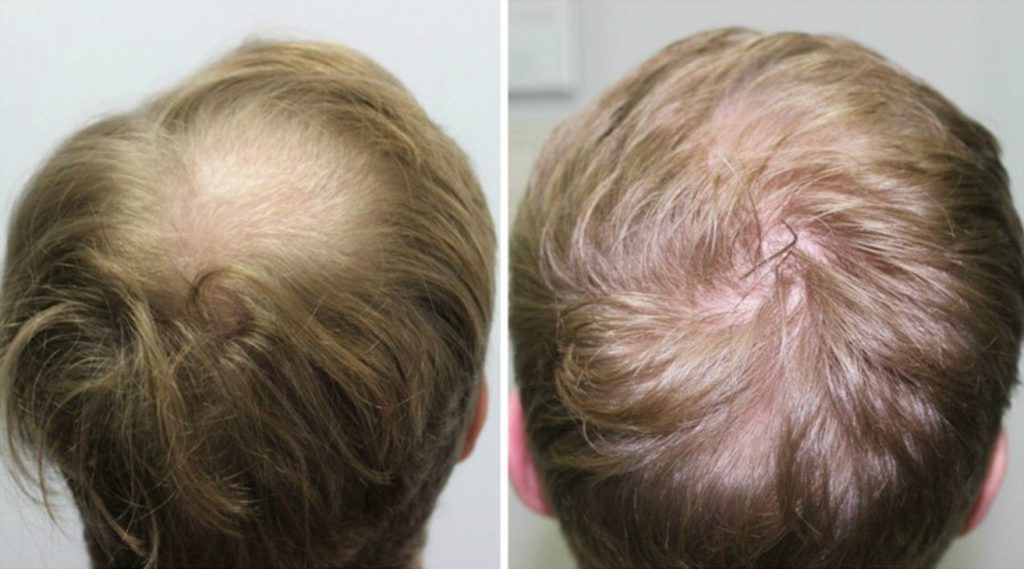 FUT Hair Transplant in Islamabad Rawalpindi & Pakistan | FUT Strip Cost