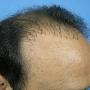 Advantages Of Follicular Unit Extraction Transplant - SKN Cosmetics