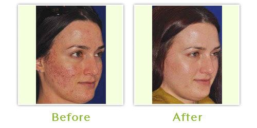 burn victims before and after plastic surgery