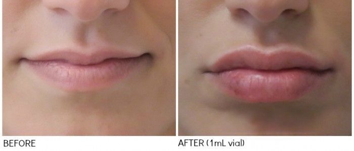 Lip Augmentation In Islamabad Rawalpindi And Pakistan Lip Injections