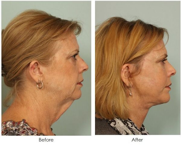 Neck Lift Surgery in Islamabad, Rawalpindi & Pakistan - Neck Lipo