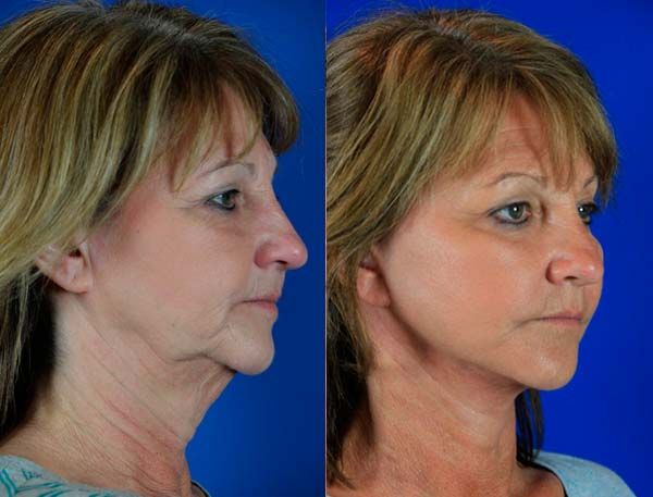 Neck Lift Surgery In Islamabad Rawalpindi Pakistan Neck Lipo