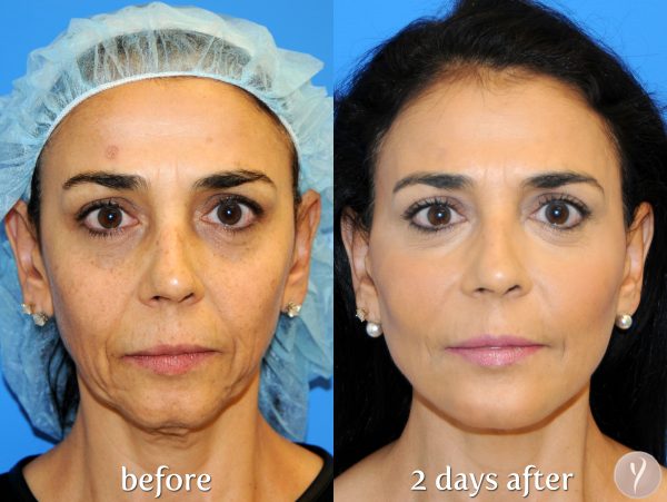 Non-Surgical Facelift in Islamabad, Rawalpindi, Peshawar & Pakistan