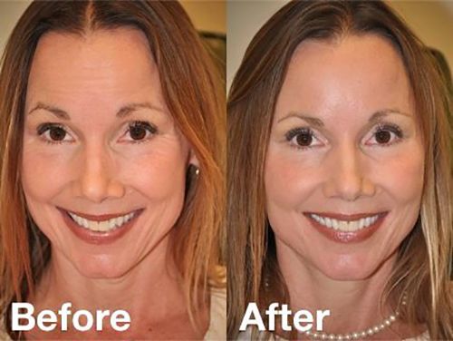 Frown Line Removal in Islamabad, Rawalpindi & Pakistan - Xeomin Treatment