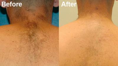 Laser Hair Removal in Islamabad, Rawalpindi, Pakistan