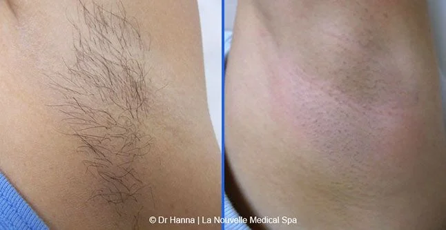 Laser Hair Removal in Islamabad, Rawalpindi