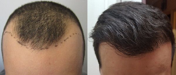 FUE Hair Transplant in Islamabad, Rawalpindi | Best FUE Hair Transplant