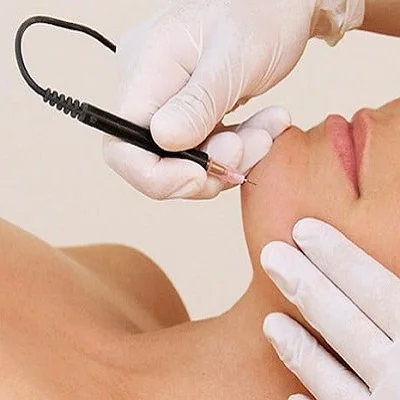 Electrolysis Hair Removal in Islamabad, Rawalpindi & Pakistan