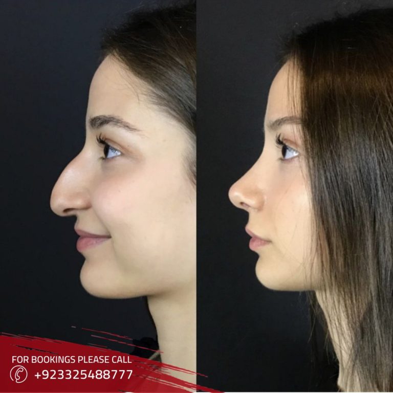 Rhinoplasty in Islamabad Pakistan | Nose Reshaping Cost