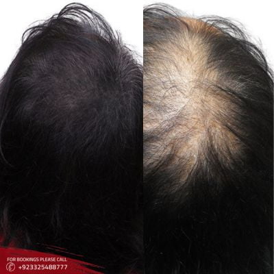 Scalp Micropigmentation (SMP) in Islamabad, Rawalpindi & Pakistan