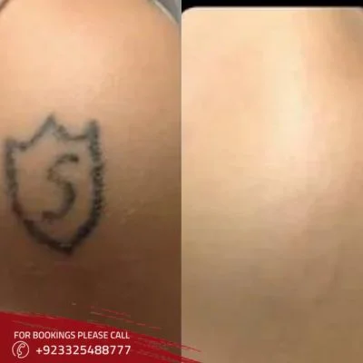 laser tattoo removal in Islamabad